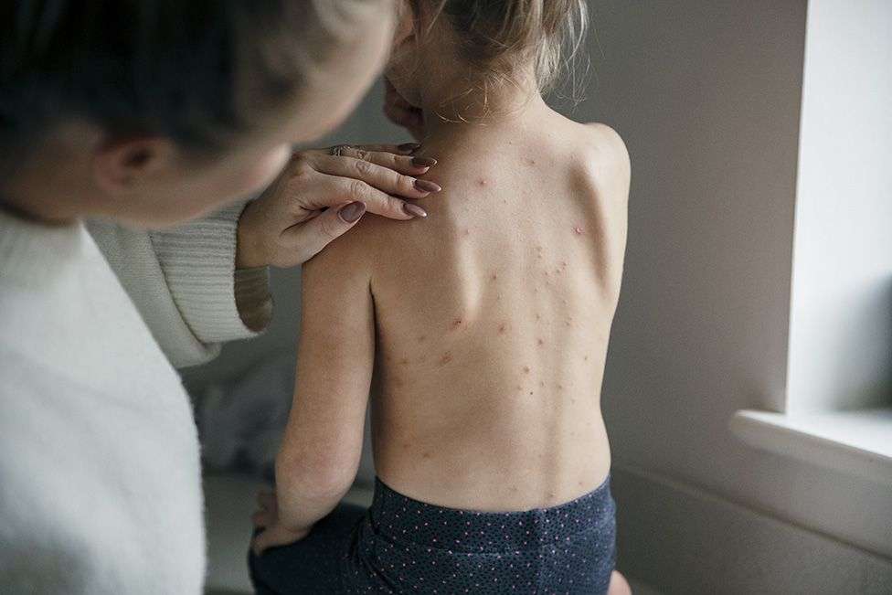 Give toddlers chickenpox jab, advisers tell NHS