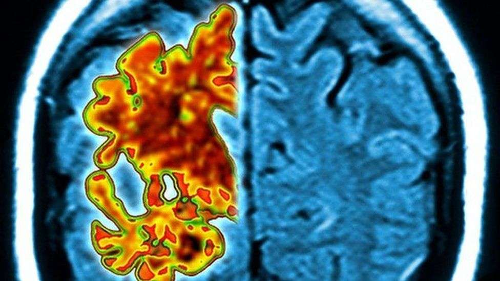 Medicine stopped in 1980s linked to rare Alzheimer's cases