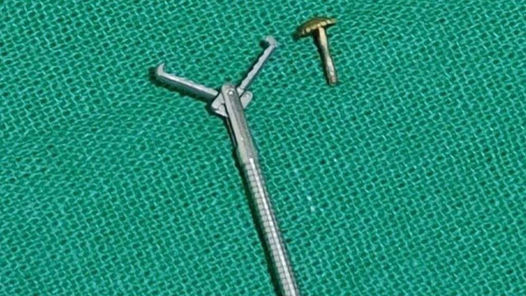 Surgery for Indian woman who inhaled nose pin