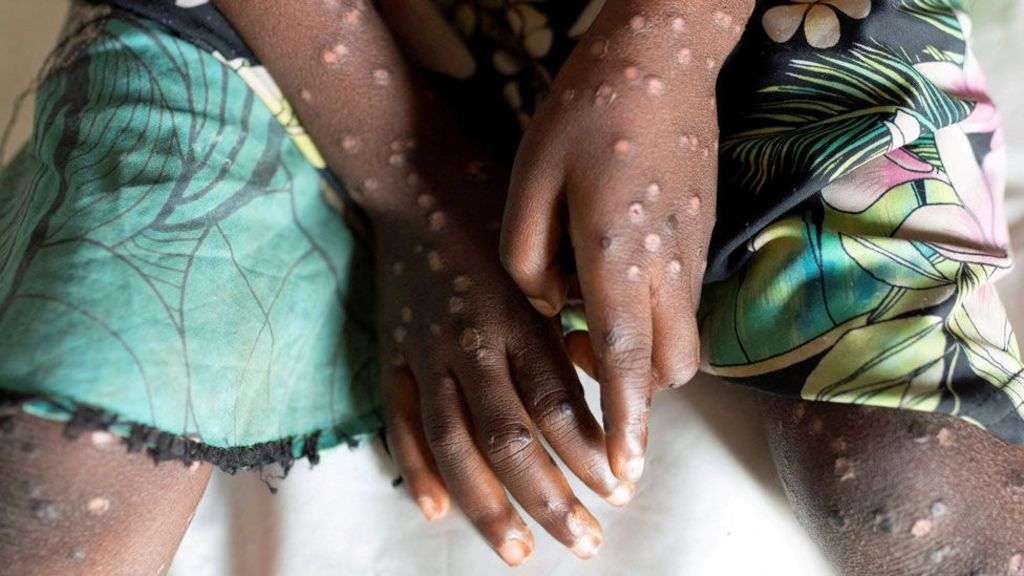 Mpox declared public health emergency in Africa