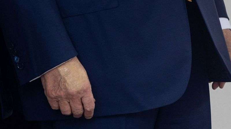 White House says Trump diagnosed with vein condition after questions about bruises